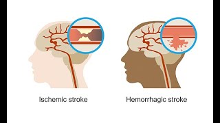 Recognizing hemorrhagic strokes–Neurology Masterclass [upl. by Annadiana190]