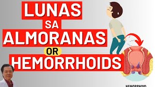 Lunas sa Almoranas or Hemorrhoids  By Doc Willie Ong [upl. by Agle]