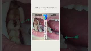 حشوات تجميلية esthetic fillings اكسبلور food happy ترند satisfying dentist explore طعامصحي [upl. by Vacla]