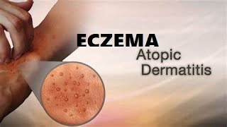 What is Eczema A Type of skin condition I Atopic Dermatitis I Allergic eczema I Neurodermatitis [upl. by Gnues]