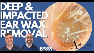 DEEP amp IMPACTED EAR WAX REMOVAL  EP891 [upl. by Ehcor687]