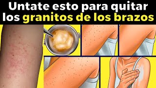 Cómo quitar los granitos de los brazos 🐔😱 queratosis pilar [upl. by Hembree930]