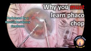 Why you MUST learn PhacoChop Resident Cataract Surgery Case [upl. by Ailey]