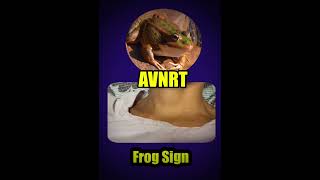 Frog Sign AVNRT [upl. by Esilana]