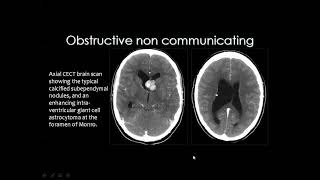 Hydrocephalus in pediatrics by Prof Mamdouh Mahfouz Organized by Dr Ramy ElSherbini 1932019 [upl. by Dnalevelc]