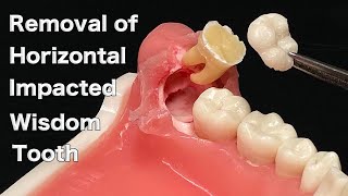 Wisdom Teeth Removal  Tooth Sectioning Procedure Surgical Guide  Online Courses [upl. by Ayotaj]