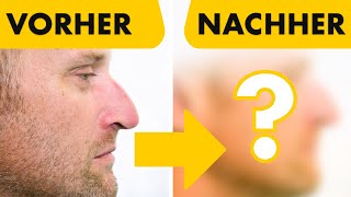 GESCHLOSSENE NasenOP 2 Vorher  Nacher Ergebnisse  Nasenkorrektur beim Mann  Dr Jungwirth [upl. by Eilyak]