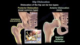 Dislocation of the hip  Everything You Need To Know  Dr Nabil Ebraheim [upl. by Cicenia516]