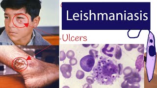 Leishmaniasis  Symptoms and Treatment of Leishmaniasis Explained under 3 minutes [upl. by Jaqitsch59]