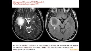 61 Astrocytoma IDHmutant grade 2 amp 3 diffuse amp anaplastic astrocytoma IDH oncometabolite [upl. by Nosam]