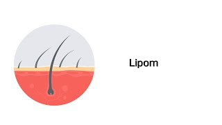 Lipom  Erkrankungen der Haut mit Infoleiste [upl. by Sirovat82]