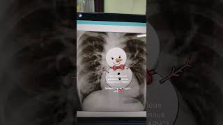 Total anomalous pulmonary venous connections TAPVC medicalcollege music neetpg neetug [upl. by Nudd]