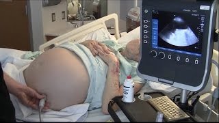 Ultrasound for Paracentesis  BAVLS [upl. by Kristien614]