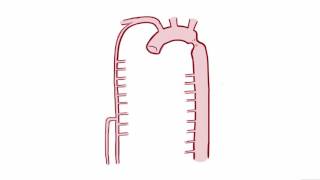 Coarctation of the Aorta CoA repair causes symptoms amp pathology [upl. by Ely662]