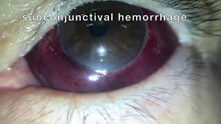 Subconjunctival hemorrhage hyposphagma [upl. by Sema529]