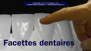 Facettes dentaires  No 15 etapes  Dr Éric Hazan Paris 16 [upl. by Kartis]