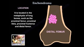 Enchondroma  Everything You Need To Know  Dr Nabil Ebraheim [upl. by Adle]