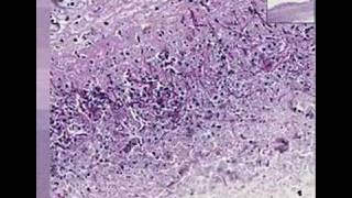 Histopathology Colon esophagus Candidiasis [upl. by Agnew]