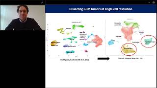 Multivalent RNA CART cell for malignant glioma [upl. by Knox]