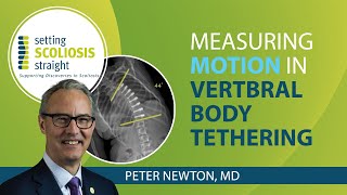 Evaluating Spinal Motion Vertebral Body Tethering vs Spinal Fusion [upl. by Nies]