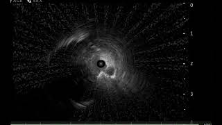 Cone beam CT guided Biopsy [upl. by Fuller]