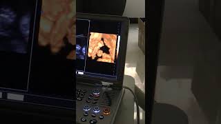 Color Doppler Ultrasound Scannerreal time fetal [upl. by Hanauq613]