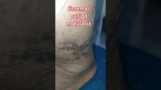 EczemaPurigo nodularis skincare visit Anm Herbal Health and skincare clinic Lucknow [upl. by Eran]