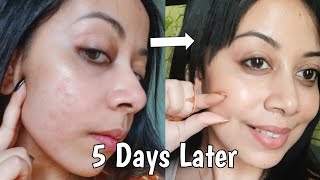 How I Repaired My Skin Barrier in 5 Days At Home Affordable Products skincare [upl. by Elamef576]