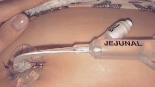 J tube placement [upl. by Noslien766]