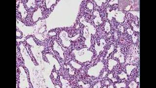 Histopathology Lung Interstitial pneumonia [upl. by Nnylyrehc82]