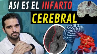 ATENCIÓN¡ Síntomas y causas de los INFARTOS CEREBRALES 💥🧠 [upl. by Benton]