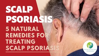 Scalp Psoriasis 5 Natural Remedies For Treating Scalp Psoriasis [upl. by Strong]