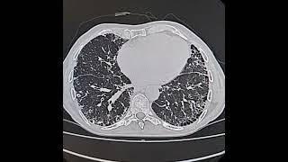 Usual interstitial pneumoniaIdiopathic pulmonary fibrosis [upl. by Imot]