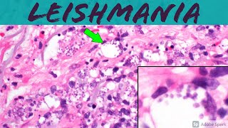 Leishmaniasis Leishmania Infection 5Minute Pathology Pearls ‪Dermatology Dermatopathology [upl. by Goss785]