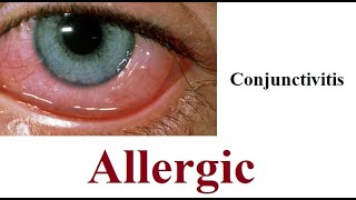 Allergic Conjunctivitis [upl. by Amik]