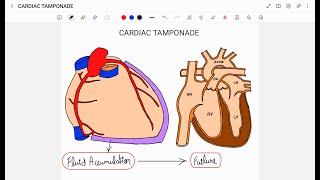 CARDIAC TAMPONADE [upl. by Abixah]