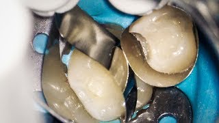 Dentist Filling a Cavity in Baby Teeth Tooth Decay at 16x Magnification [upl. by Esinyt187]