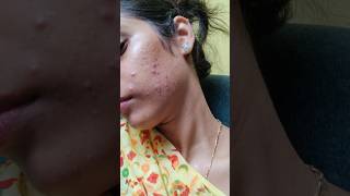 Charusheela ki pimples  Oily skin Acne prone skin tips  telugu girl skin care  Telugu mini vlogs [upl. by Kcinnay]