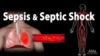 Sepsis and Septic Shock Animation [upl. by Jacques146]