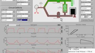 Incompetent Expiratory Valve in anesthesia machine [upl. by Lainey]