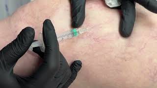 Microsclerotherapy for thread veins at Rediscovered Skin Clinic  Bournemouth Dorset [upl. by Esilec]