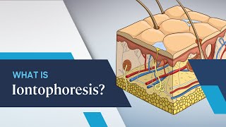 What is Iontophoresis [upl. by Tatum]