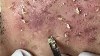 Ultimate Acne amp Blackhead Removal Guide Clear Skin Transformation [upl. by Consuelo668]