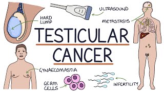 Understanding Testicular Cancer [upl. by Saunders]