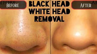 BlackheadWhiteheads Removing  Do this to Remove BlackheadsWhiteheads from Nose [upl. by Aliemaj]