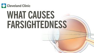 What Causes Farsightedness [upl. by Sivat]