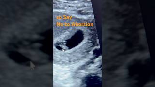 6weeks baby in ultrasound earlypregancy abortionfetal pregnant pregnancyjourney ytshorts baby [upl. by Anerbas]