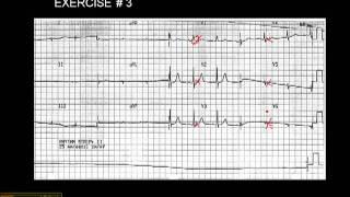 1215 Lead ECG Exercise  3 [upl. by Aniala]