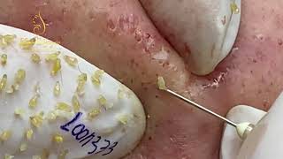 Blackheads removal 333b  Loan Nguyen [upl. by Munford]