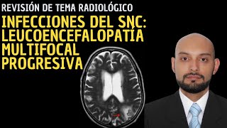 Radiología en 5 minutos Infecciones del SNC Leucoencefalopatía multifocal progresiva [upl. by Landel]